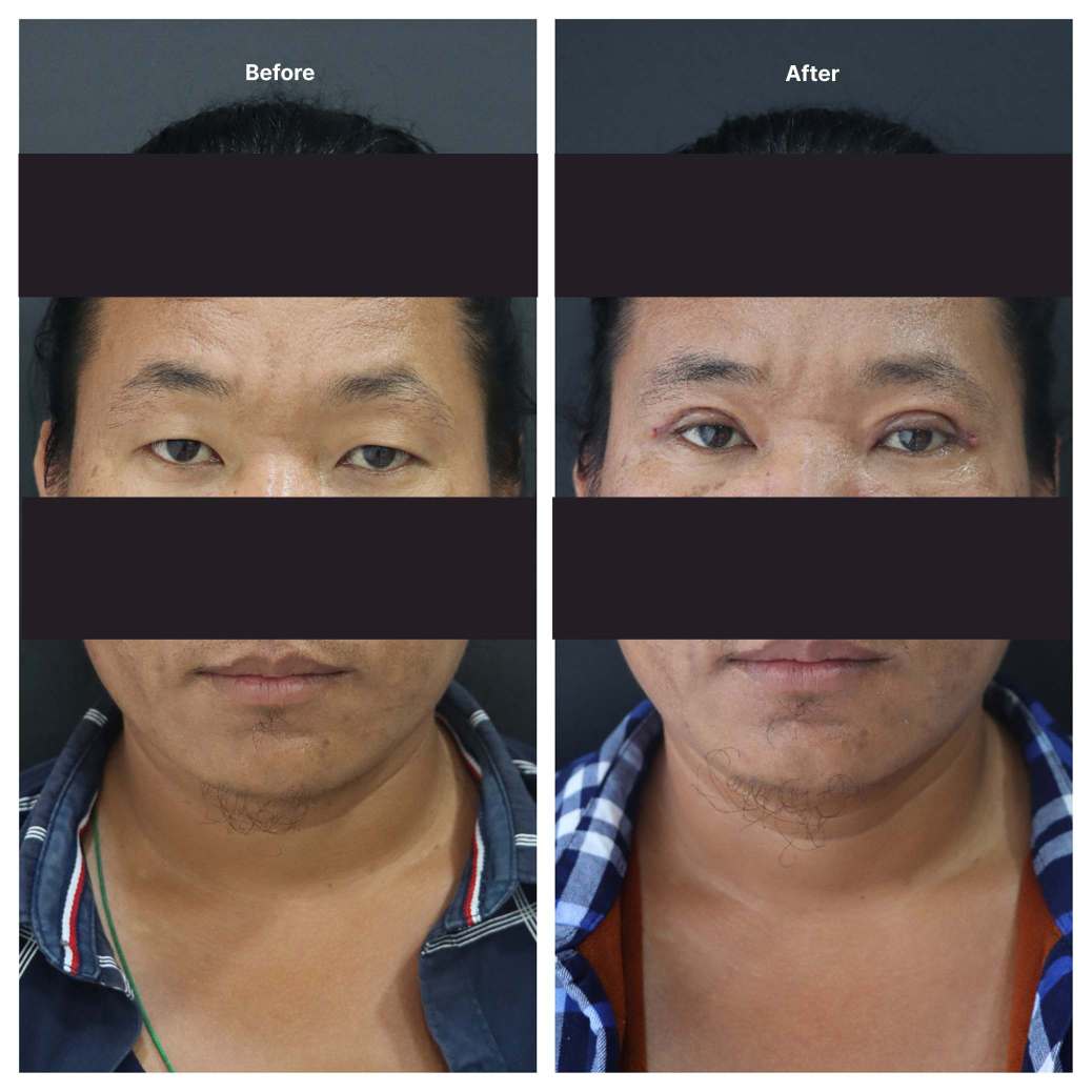 Eyelid Surgery KOQ10